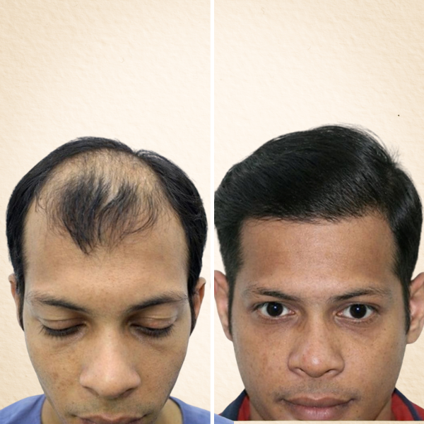 Hair transplant before and after results – patient treated by Dr. Nikitha Reddy at DermaHT, Hyderabad