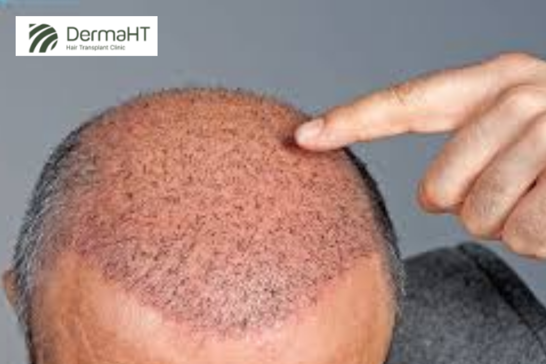 Can I Get FUE Without Shaving My Head?