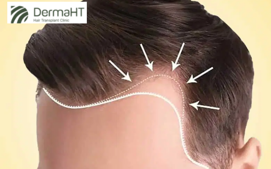 FUE for Receding Hairline: What to Expect