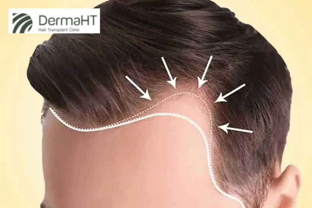 FUE for Receding Hairline: What to Expect