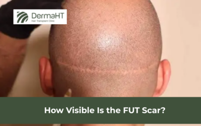 How Visible Is the FUT Scar?