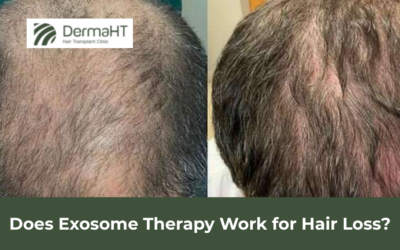 Does Exosome Therapy Work for Hair Loss?