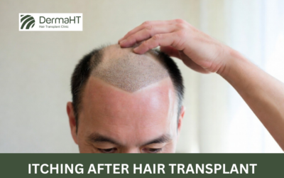  Itching After Hair Transplant: Causes & Relief