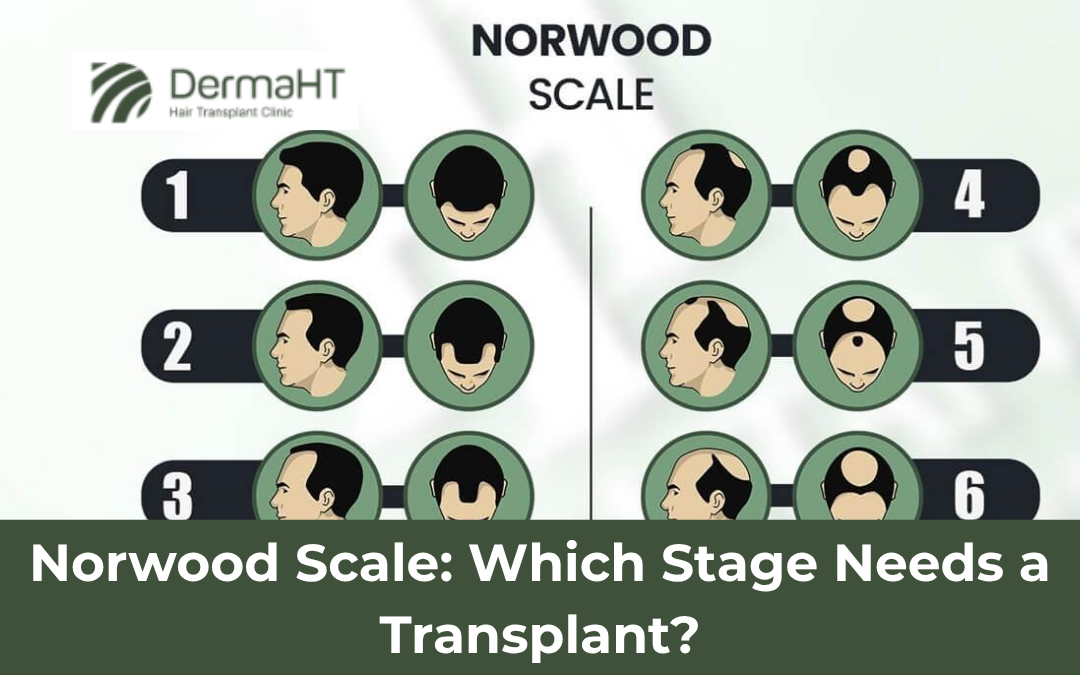 Norwood Scale of hair transplant