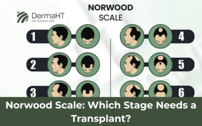 Norwood Scale: Which Stage Needs a Transplant?
