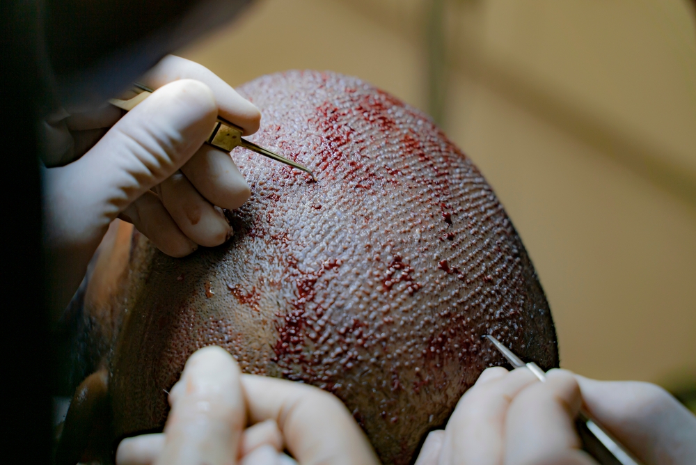 Surgical Restoration – follicular unit extraction at DermaHT, Hyderabad
