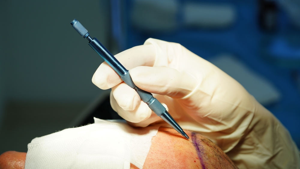 Non-surgical hair restoration treatments – PRP, GFC, exosomes and mesotherapy at DermaHT Hyderabad