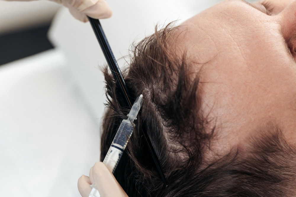 Mesotherapy for hair transplant