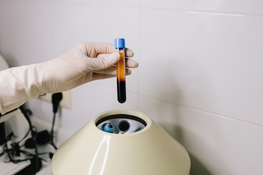 PRP Hair Transplant